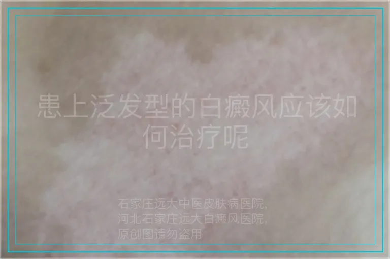 患上泛发型的白癜风应该如何治疗呢