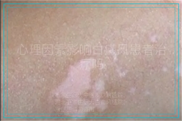 心理因素影响白癜风患者治疗吗