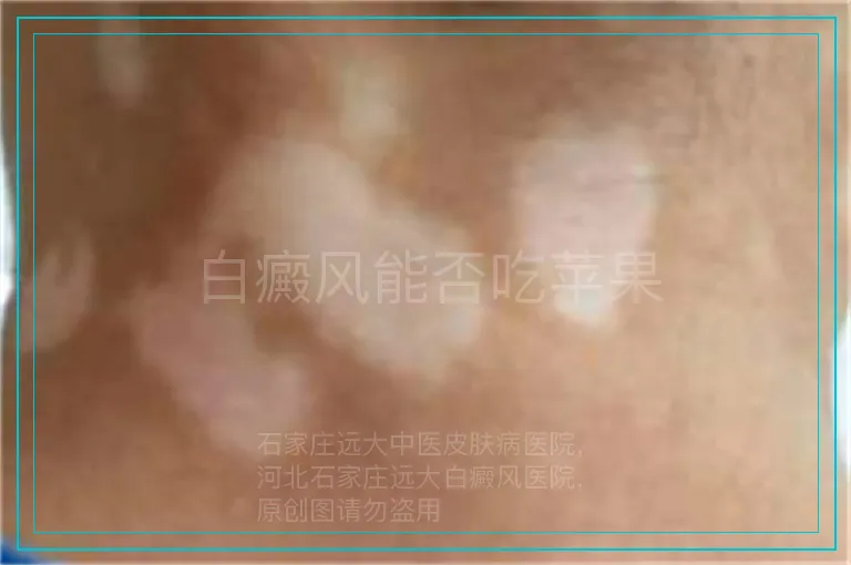 白癜风能否吃苹果