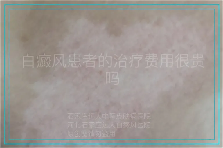 白癜风患者的治疗费用很贵吗