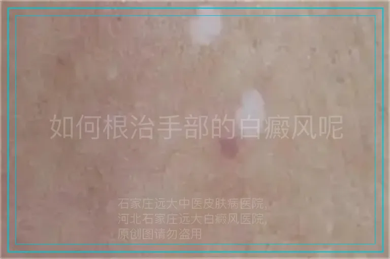 如何根治手部的白癜风呢