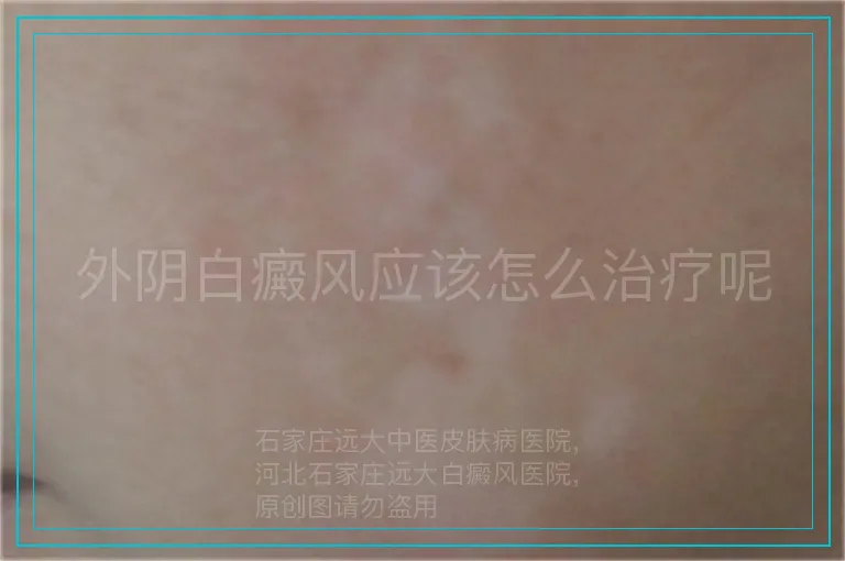 外阴白癜风应该怎么治疗呢