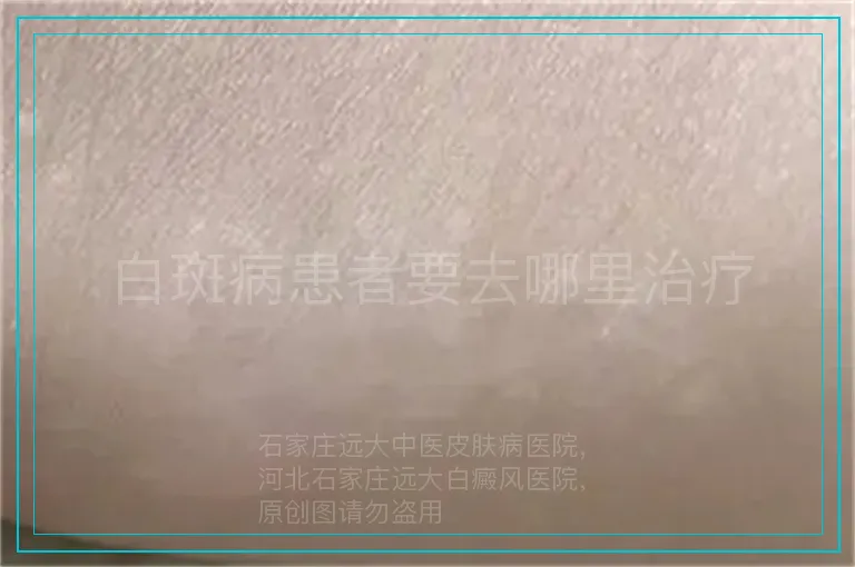 白斑病患者要去哪里治疗
