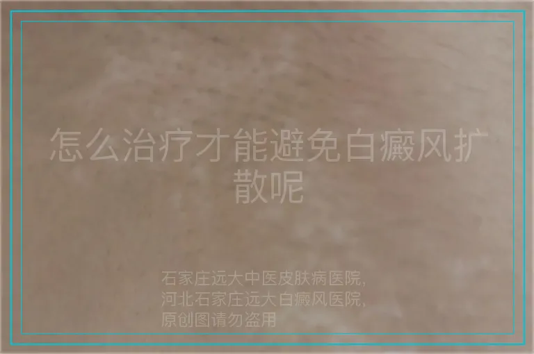 怎么治疗才能避免白癜风扩散呢