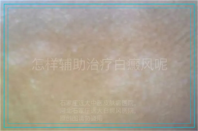 怎样辅助治疗白癜风呢