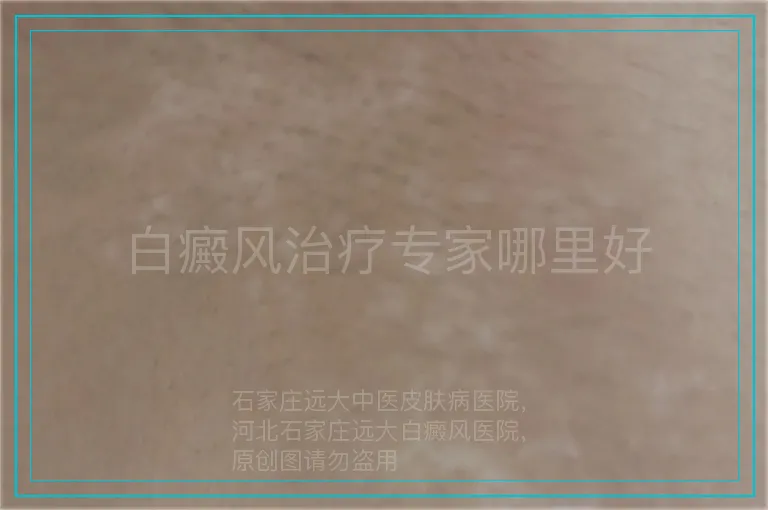 白癜风治疗专家哪里好