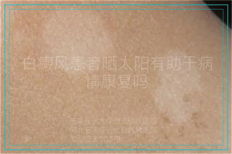 白癜风患者晒太阳有助于病情康复吗
