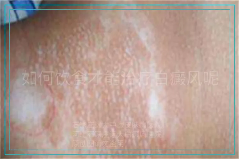 如何饮食才能治疗白癜风呢