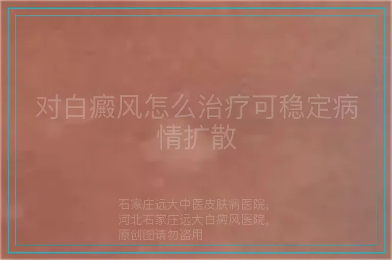 对白癜风怎么治疗可稳定病情扩散