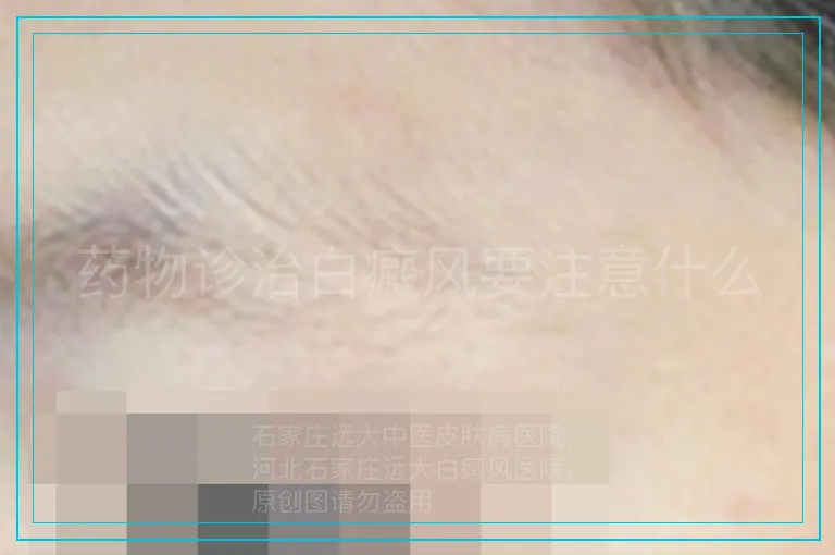 药物诊治白癜风要注意什么