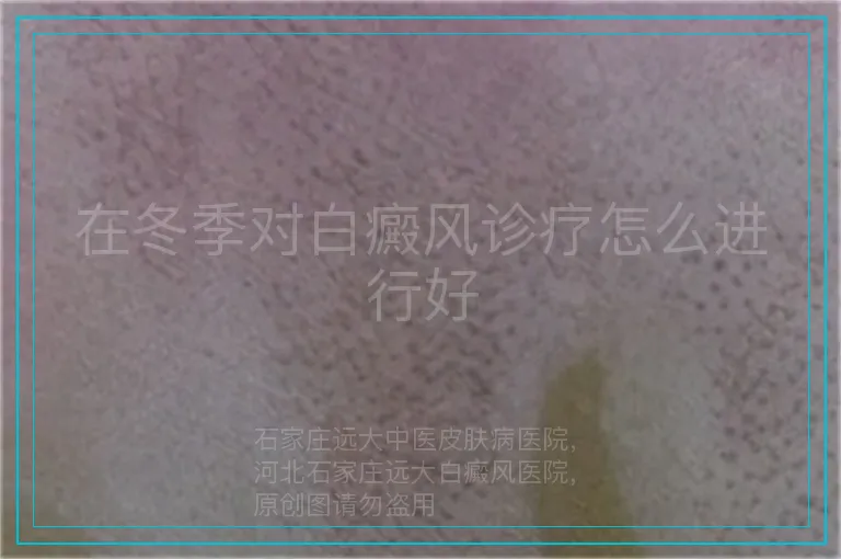 在冬季对白癜风诊疗怎么进行好