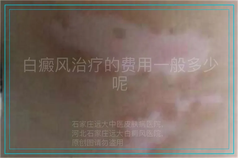 白癜风治疗的费用一般多少呢