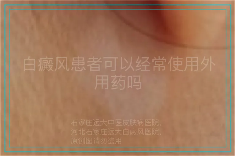 白癜风患者可以经常使用外用药吗
