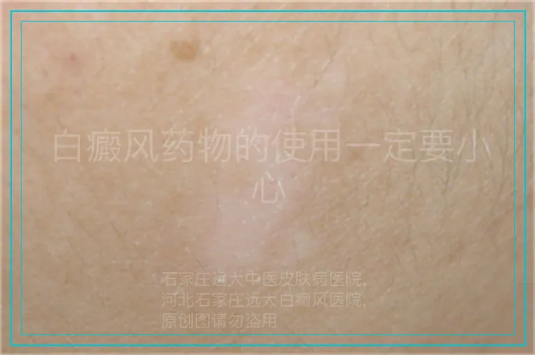 白癜风药物的使用一定要小心