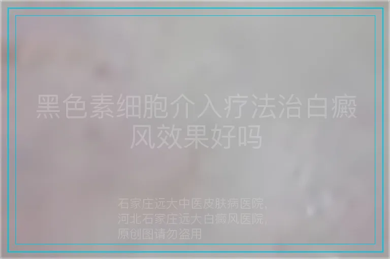 黑色素细胞介入疗法治白癜风效果好吗
