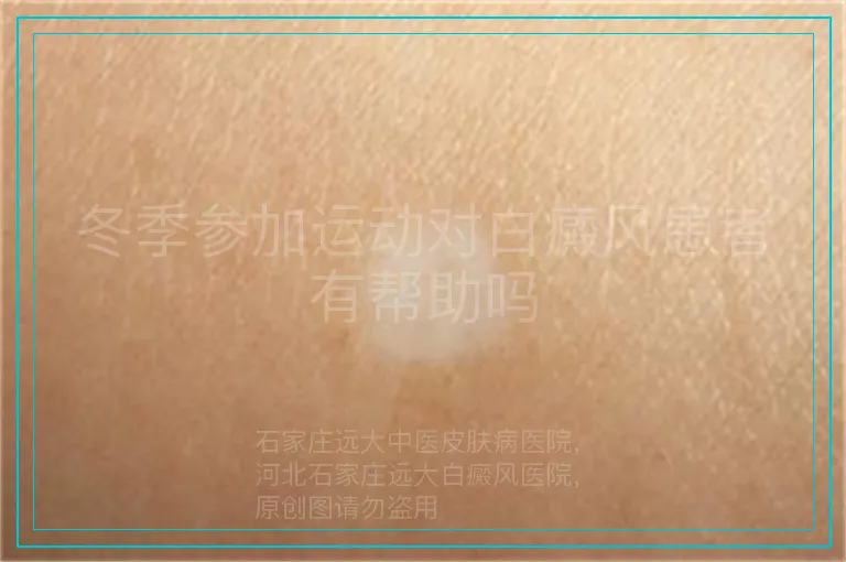 冬季参加运动对白癜风患者有帮助吗