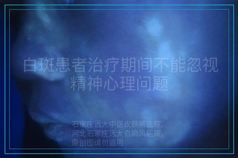 白斑患者治疗期间不能忽视精神心理问题