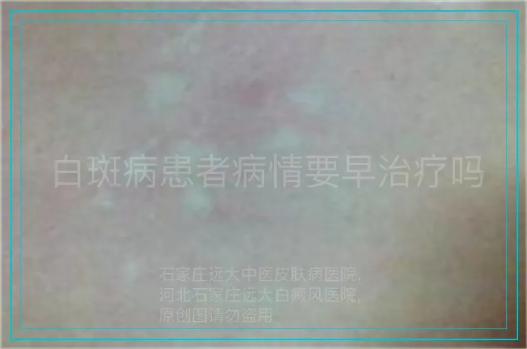 白斑病患者病情要早治疗吗