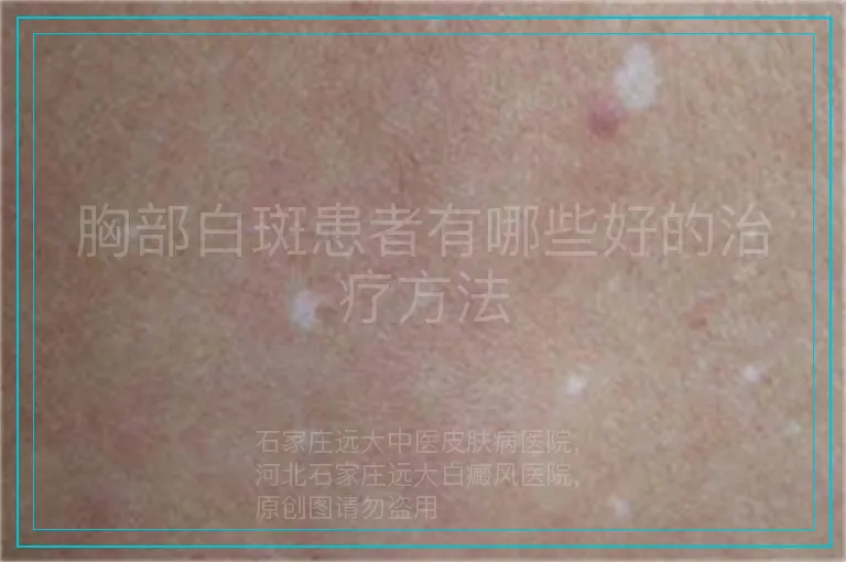 胸部白斑患者有哪些好的治疗方法