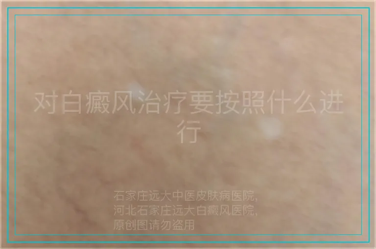 对白癜风治疗要按照什么进行