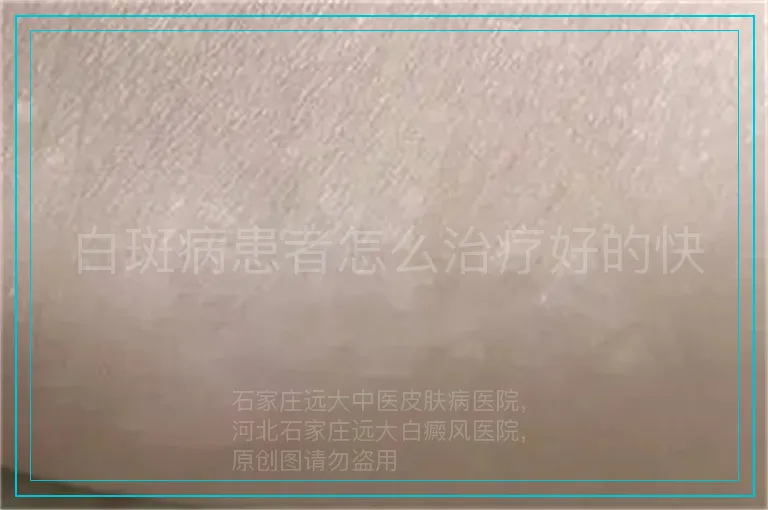 白斑病患者怎么治疗好的快