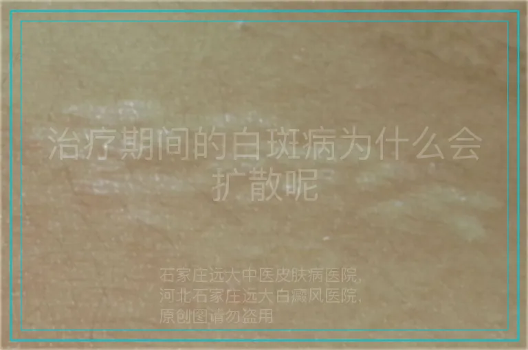 治疗期间的白斑病为什么会扩散呢