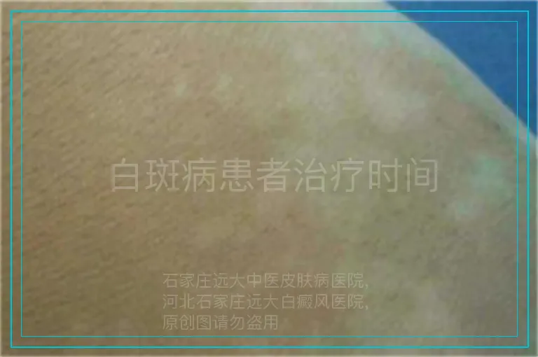 白斑病患者治疗时间