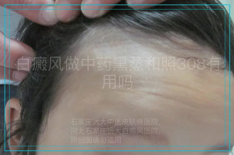 白癜风做中药熏蒸和照308有用吗