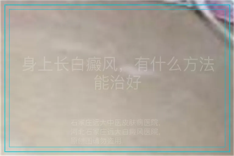 身上长白癜风,有什么方法能治好