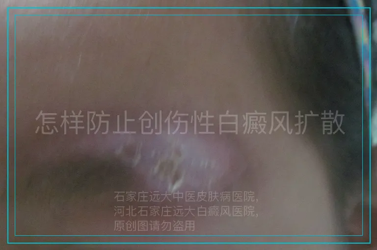 怎样防止创伤性白癜风扩散