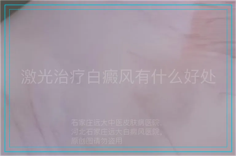 激光治疗白癜风有什么好处
