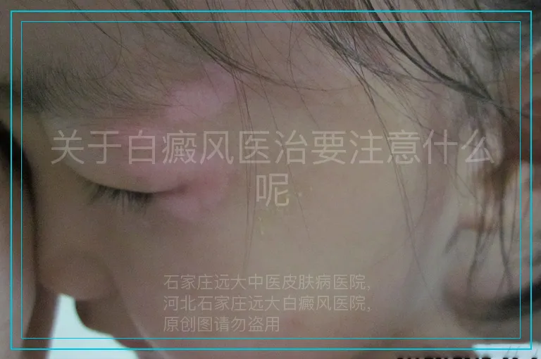 关于白癜风医治要注意什么呢