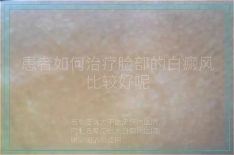患者如何治疗脸部的白癜风比较好呢