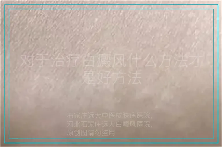 对于治疗白癜风什么方法才是好方法