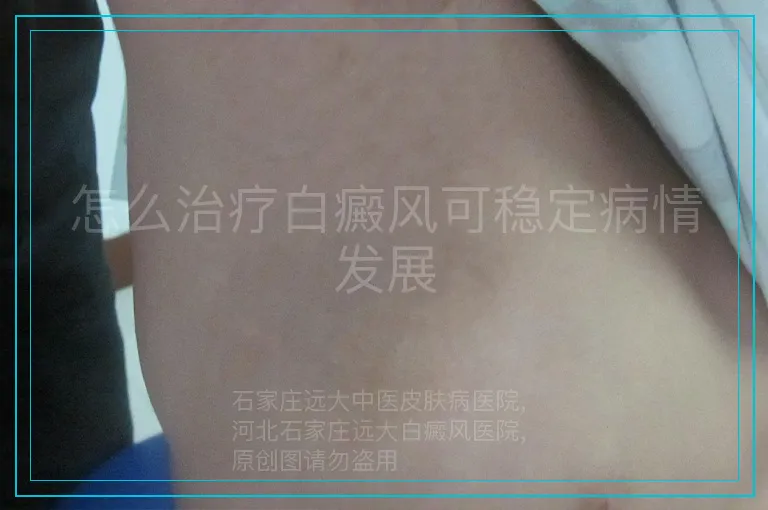 怎么治疗白癜风可稳定病情发展