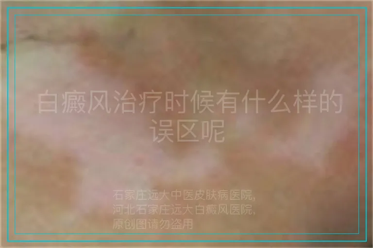 白癜风治疗时候有什么样的误区呢