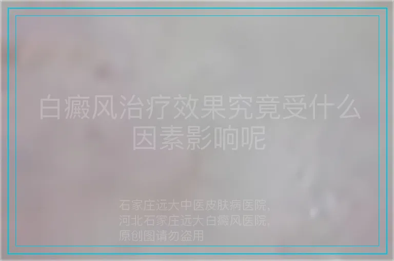 白癜风治疗效果究竟受什么因素影响呢