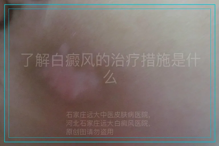 了解白癜风的治疗措施是什么