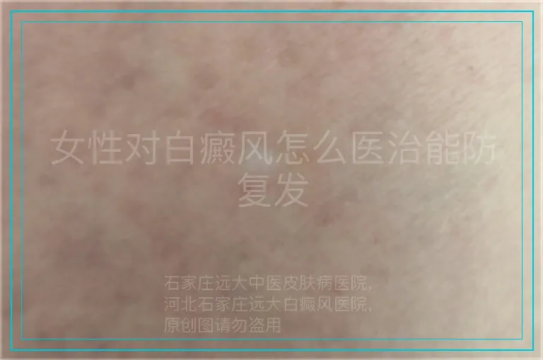 女性对白癜风怎么医治能防复发