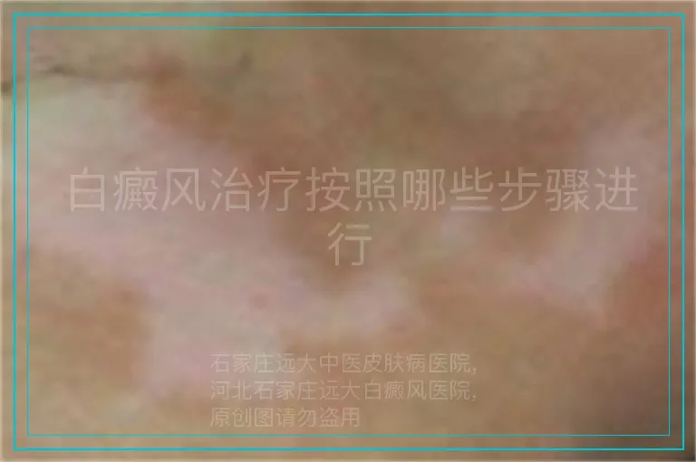 白癜风治疗按照哪些步骤进行