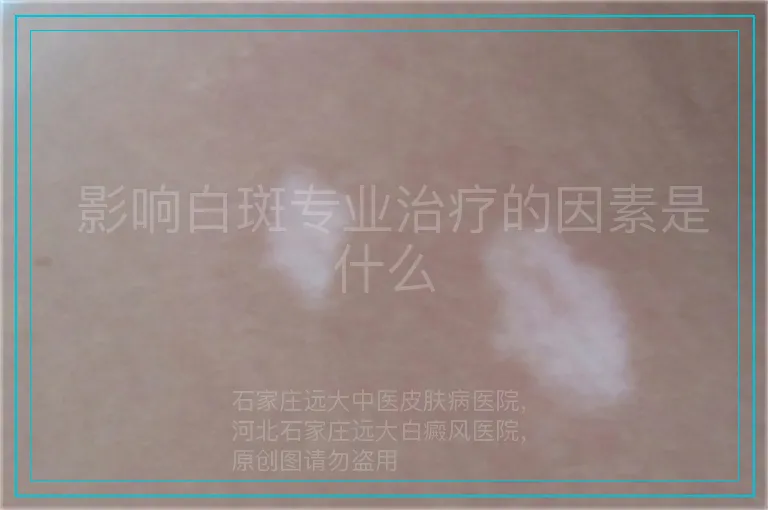 影响白斑专业治疗的因素是什么