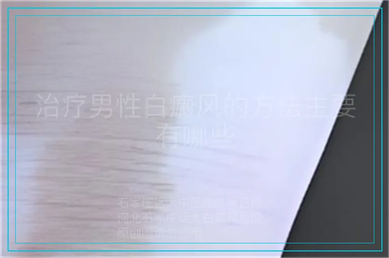 治疗男性白癜风的方法主要有哪些
