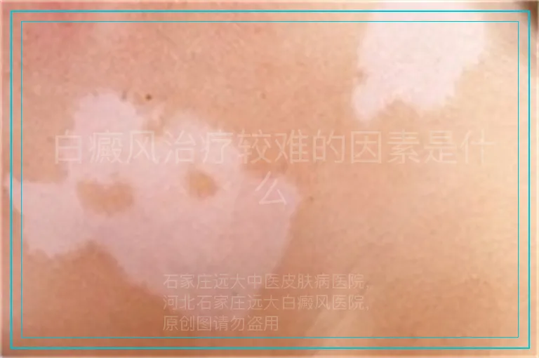 白癜风治疗较难的因素是什么