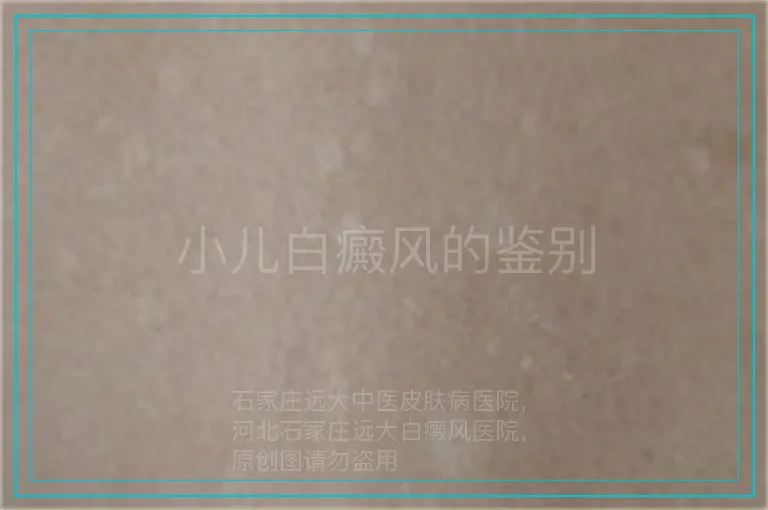 小儿白癜风的鉴别