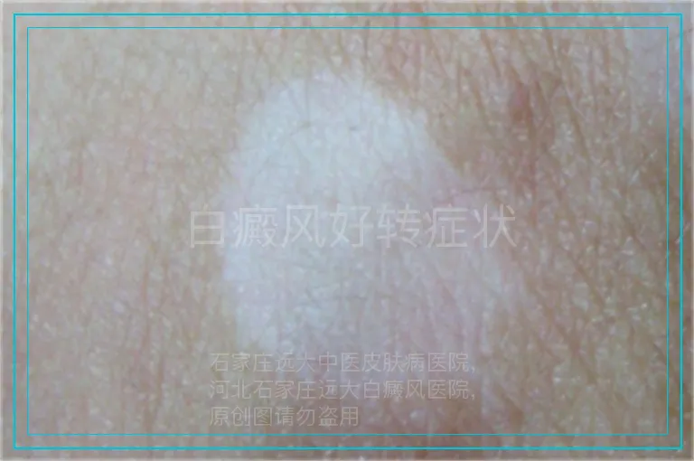 白癜风好转症状