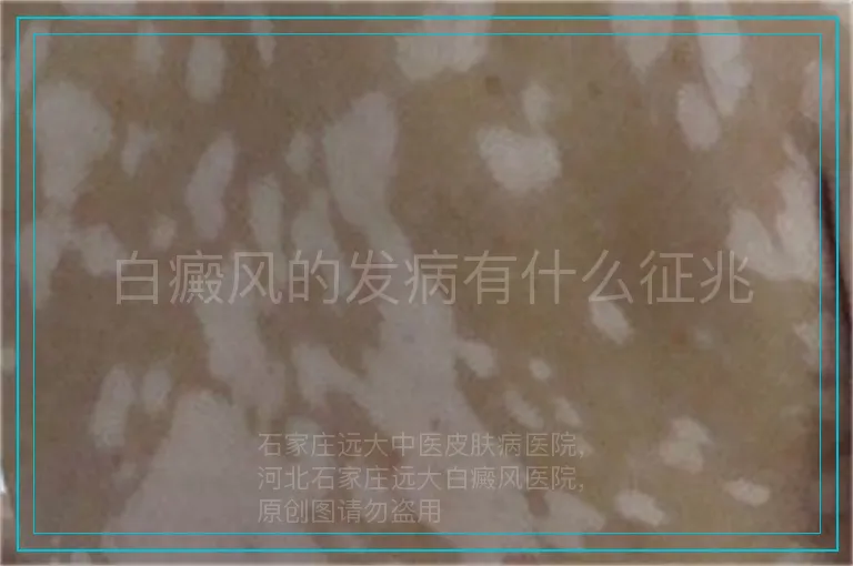 白癜风的发病有什么征兆