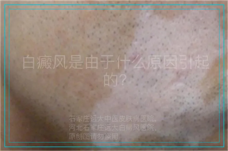 白癜风是由于什么原因引起的?
