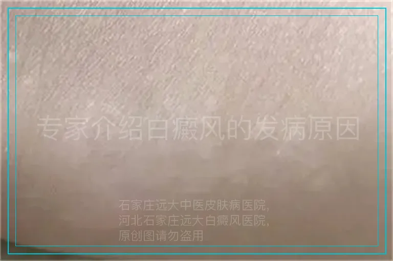 专家介绍白癜风的发病原因
