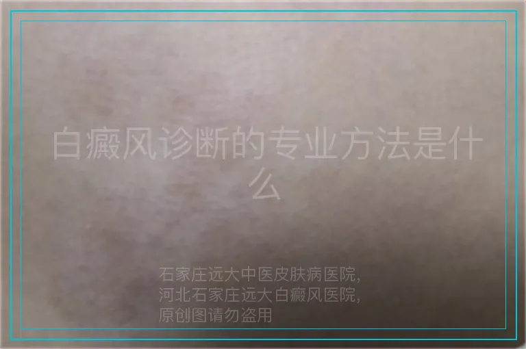 白癜风诊断的专业方法是什么