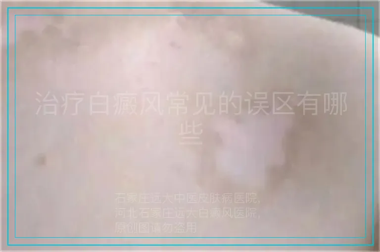 治疗白癜风常见的误区有哪些